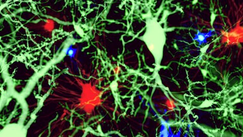 Entzündete Hirnzellen (Foto: IMAGO, imago/Science Photo Library)