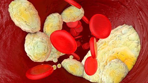 Arteriosklerose. Ein erhöhter LDL-Cholesterinspiegel kann das Risiko von Herz-Kreislauf-Erkrankungen erhöhen. (Foto: IMAGO, imago images / Westend61)