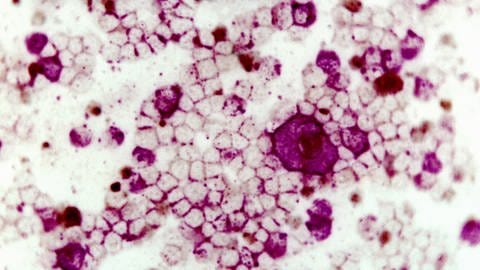 Colorierte Mikroskopaufnahme des Respiratory Ssyncytial Virus (RSV) (Foto: IMAGO, IMAGO / Image Source)