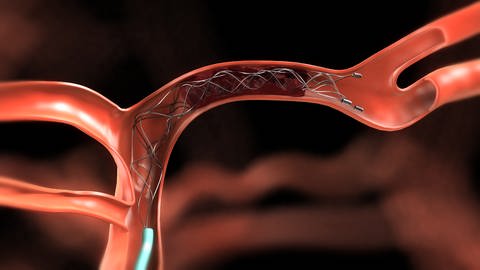Animation eines Stents in einer Arterie (Foto: picture-alliance / Reportdienste, dpa/Medtronic GmbH/Covidien Deutschland )