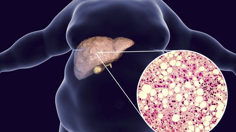 Bei der Fettlebererkrankung sammeln sich große Fettzellen in den Leberzellen an. (Foto: IMAGO, Science Photo Library)