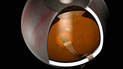 Netzhaut-Chip der Firma Retina Implant im menschlichen Auge (Foto: picture-alliance / Reportdienste, Picture Alliance)