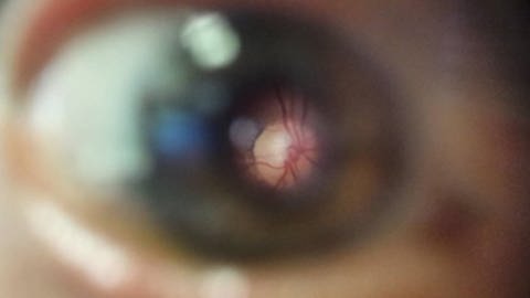 Beispiel-Bild des Augenhintergrundes mittels umgerüstetem Smartphone. Auf dem bewusst zum Augenhintergrund scharfgestellten Bildbereich (Mitte) ist der gelbliche Sehnervenkopf mit daraus austretenden Gefäßen und umgebender Netzhaut zu erkennen. (Foto: © privat/Universität Bonn/Sankara Eye Foundation)