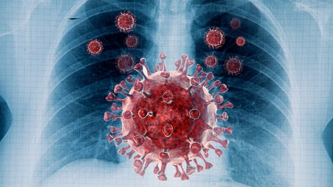 Symbolbild: Lungen-Röntgenbild mit Coronaviren. (Foto: IMAGO, IMAGO / Shotshop)