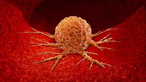  3D Illustration einer Tumorzelle im Körperinneren. (Foto: IMAGO, IMAGO / agefotostock)