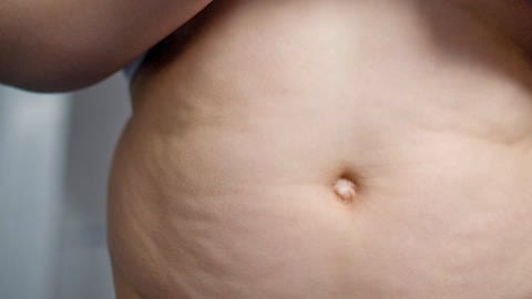 Übergewichtiger Junge zeigt Bauch (Foto: picture-alliance / Reportdienste, Picture Alliance)
