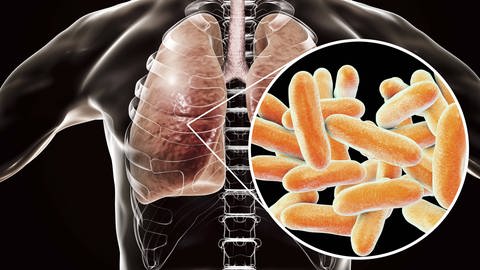 Illustration eines Legionellenbefalls an der Lunge. (Foto: IMAGO, IMAGO / Science Photo Library)
