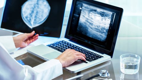 Nahaufnahme eines Arztes, der die Mammographieergebnisse auf dem Röntgenbild überprüft. (Foto: IMAGO, IMAGO / ZUMA Wire)