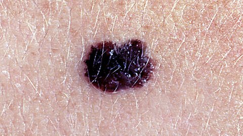 En Großteil der UV-bedingten Erkrankungen und Todesfälle, wie z.B. der schwarze Hautkrebs,  könnte durch Präventionsmaßnahmen vermieden werden. (Foto: IMAGO, IMAGO/UIG)