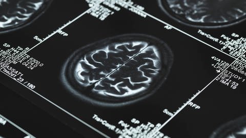 MRT Bild eines Gehirns (Foto: IMAGO, Science Photo Library)