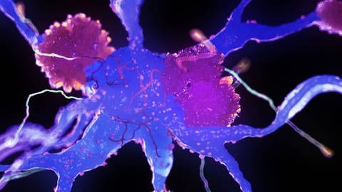 Alzheimer-Nervenzellen (Foto: IMAGO, imago images / Science Photo Library)