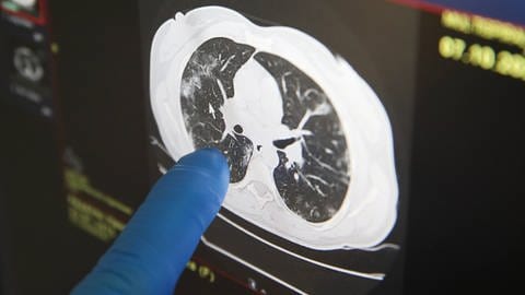 Mit Hilfe der auch mit Röntgenstrahlen funktionierenden Computertomographie wird hier die Lunge eines Covid-19 Patienten untersucht. (Foto: IMAGO, imago images/ITAR-TASS/Vladimir Gerdo)