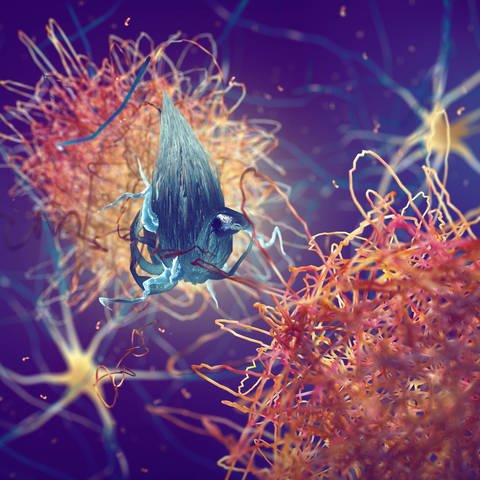 Amyloid-Plaques in einem Gehirn bei Alzheimer-Krankheit (Illustration)