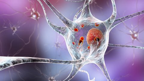 Ablagerungen von Proteinen sammeln sich bei Parkinson in den Gehirnzellen an und verursachen deren fortschreitende Degeneration.