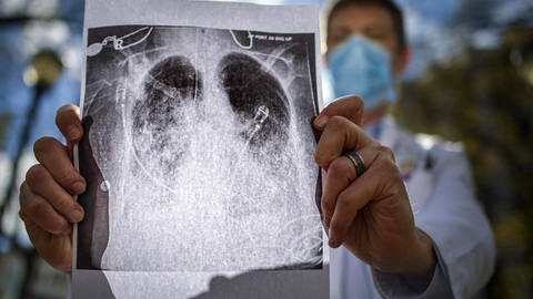 Ein Arzt hält ein gedrucktes Röntgenbild in der Hand, das die bei Covid-19-Patienten typische Doppellungenpneumonie zeigt. (Foto: IMAGO, IMAGO / ZUMA Wire)