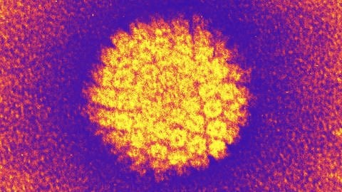 Epstein-Barr-Virus (Foto: IMAGO, imago stock&people)