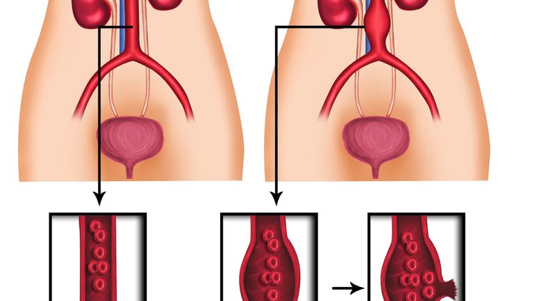 Animation: Vergleich zwischen normaler und erweiterter Aorta und stilisierte Darstellung bis zum Riss der Aorta