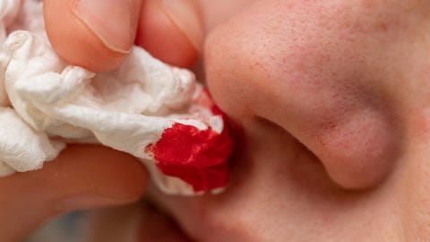 Nasenbluten kann eine mögliche Folge sein, wenn man es beim Bohren in der Nase etwas übertrieben hat. (Foto: IMAGO, IMAGO/mhphoto)
