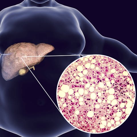 Bei der Fettlebererkrankung sammeln sich große Fettzellen in den Leberzellen an.