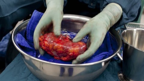 Entnommene Niere bei einer Nierentransplantation.