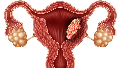 Grafik mit Krebs in Gebärmutter.  (Foto: IMAGO, IMAGO / agefotostock)