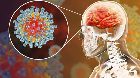 Illustration von Masern-Viren im Gehirn. (Foto: IMAGO, IMAGO / Science Photo Library)