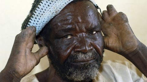 Ein junger Leprakranker hält seine verstümmelten Hände an seinen Kopf. (Foto: IMAGO, /Medicimage)