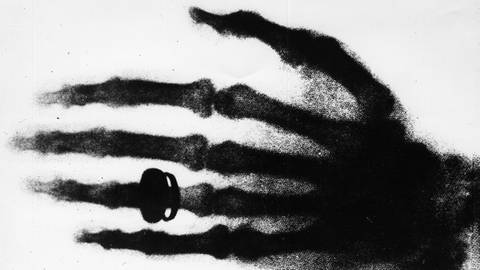 Erste Röntgenaufnahme von Wilhelm Conrad Röntgen zeigt die linke Hand seiner Frau.