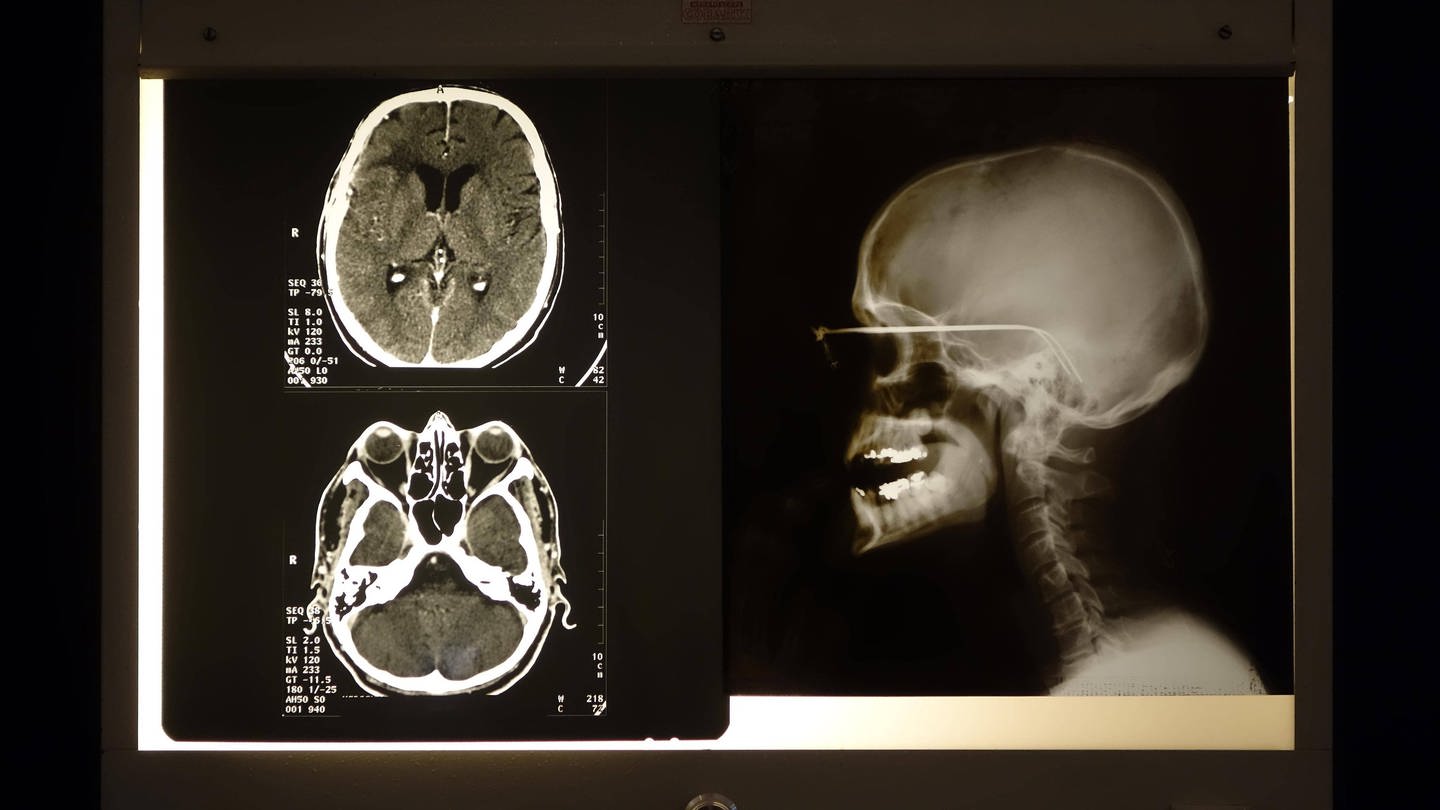 Computertomographien (CTs) erlauben ein Blick ins Hirn des Menschen. (Foto: IMAGO, IMAGO / imagebroker)