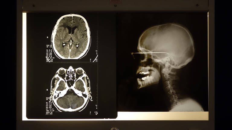 Computertomographien (CTs) erlauben ein Blick ins Hirn des Menschen.