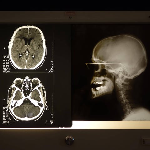 Computertomographien (CTs) erlauben ein Blick ins Hirn des Menschen.