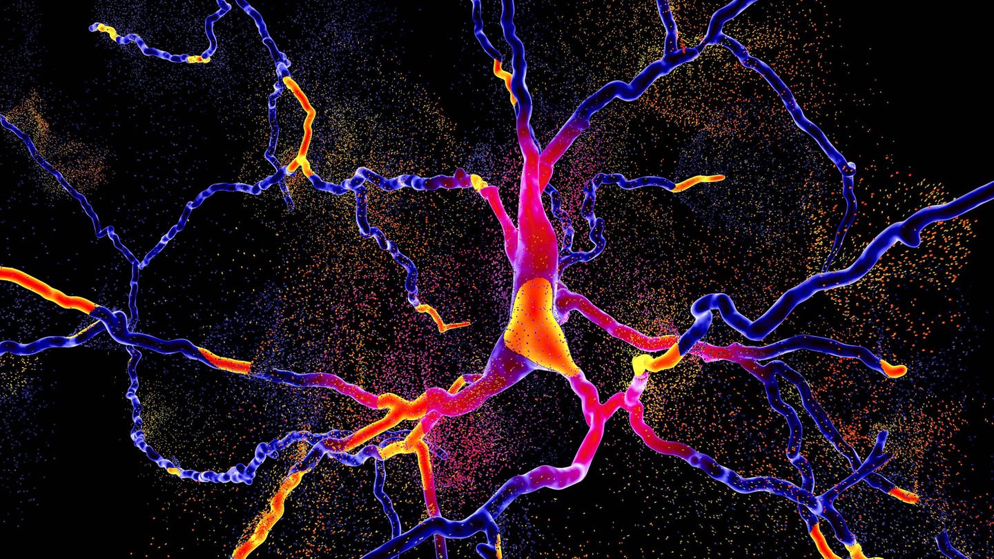 Das Bild illustriert die Degeneration eines Neurons, das für die Bildung von Dopamin zuständig ist. (Foto: IMAGO, Science Photo Library)