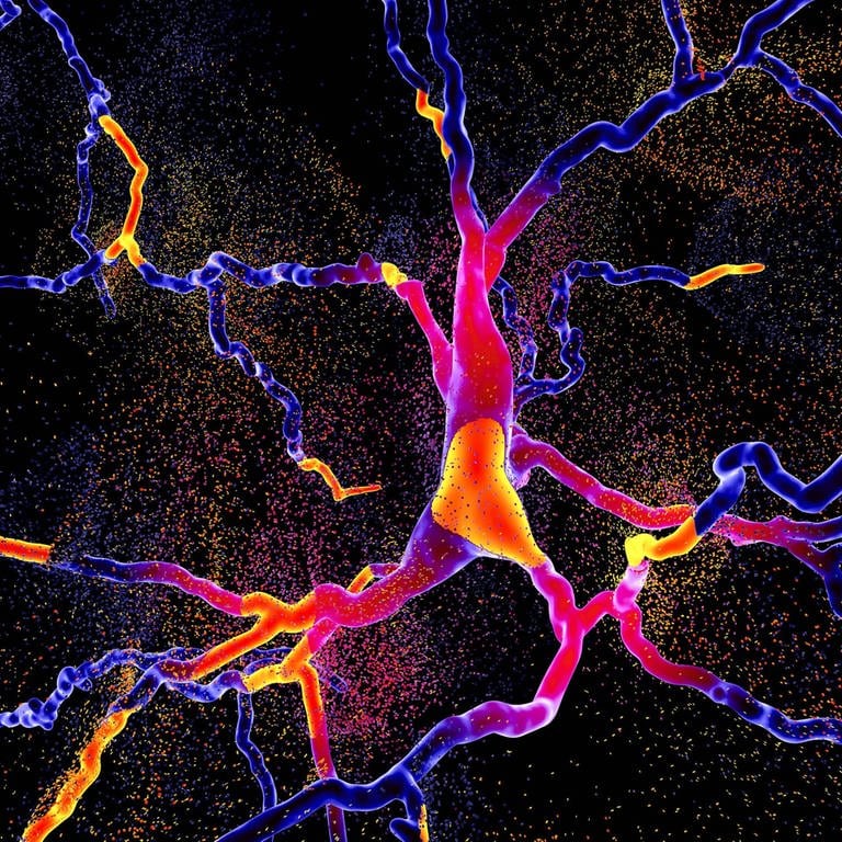 Das Bild illustriert die Degeneration eines Neurons, das für die Bildung von Dopamin zuständig ist.