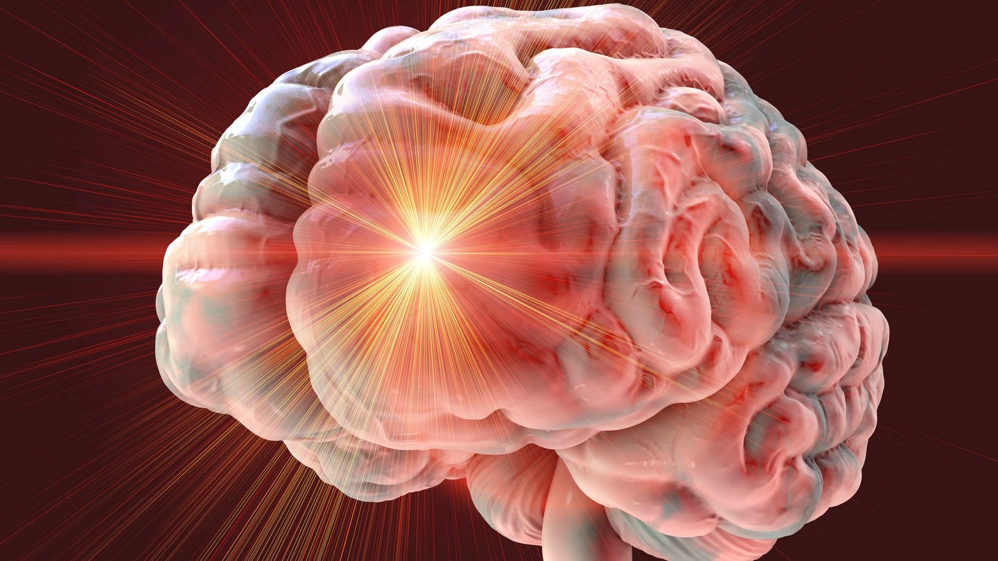 Das Bild zeigt ein Gehirn und illustriert einen Schlaganfall. (Foto: IMAGO, Science Photo Library)