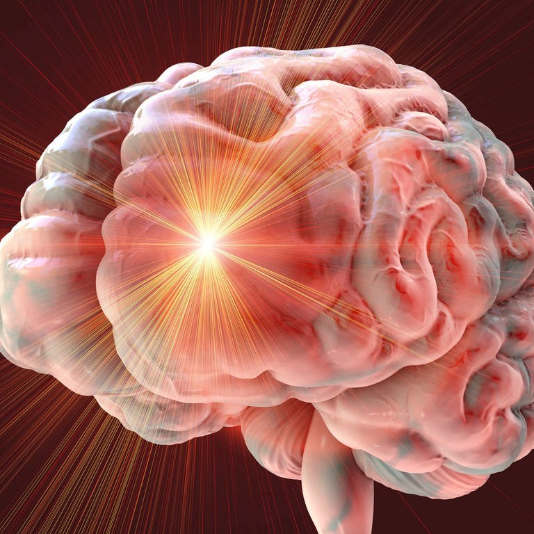 Das Bild zeigt ein Gehirn und illustriert einen Schlaganfall.