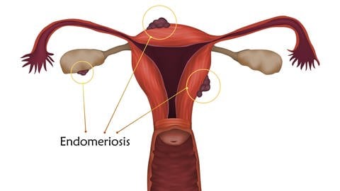 Illustration eines Uterus mit Wucherungen ausgelöst durch eine Endometriose.  (Foto: IMAGO, IMAGO / Science Photo Library)