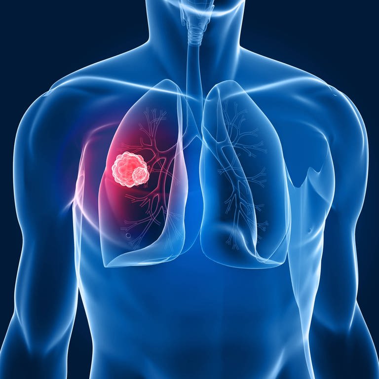 Die Illustration zeigt einen Lungentumor. (Foto: IMAGO, Design Pics)