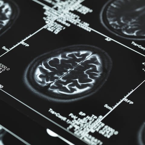 MRT Bild eines Gehirns