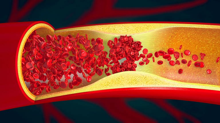 Illustration eines verstopften Blutgefäßes