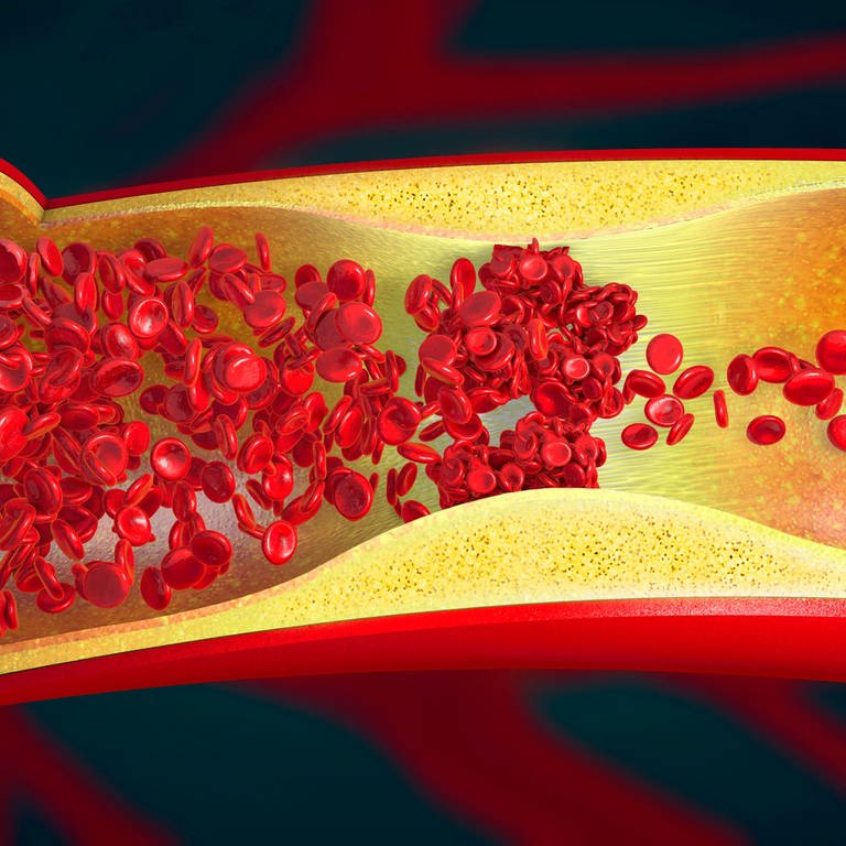 Illustration eines verstopften Blutgefäßes