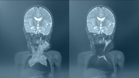 Vergleich der Röntgenbilder von Aykuts Tumor, der merklich geschrumpft ist