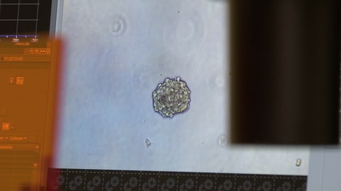Tumor unter dem Mikroskop