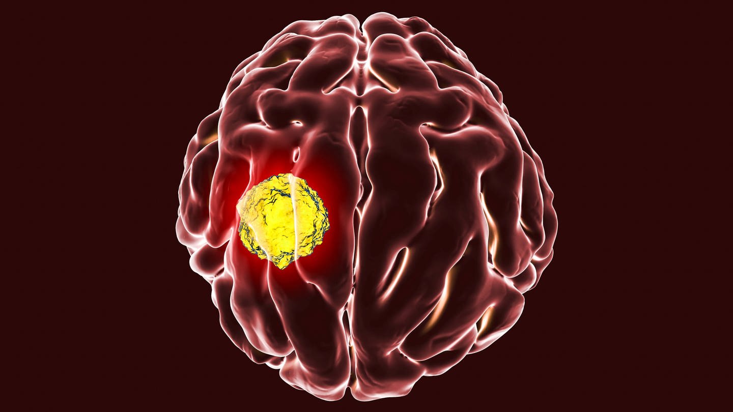 Illustration eines Gehirns mit Tumor (Foto: IMAGO, Science Photo Library)