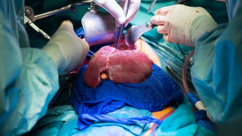 In Deutschland wurden letztes Jahr 2.877 Organe gespendet. Das sind zu wenige, wie Experten meinen | Lebertransplantation im Operationssaal. (Foto: IMAGO, IMAGO / Westend61)