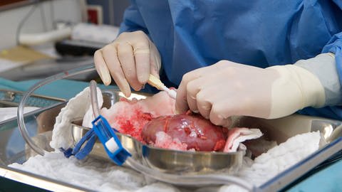 Vorbereitung für Nierentransplantation (Foto: IMAGO, imago images / epd)