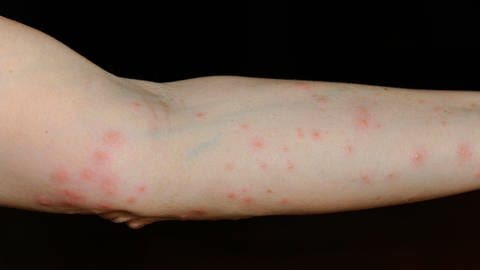 Rote juckende Pusteln auf einem Arm, ausgelöst durch Bisse der Larve der Grasmilbe (Foto: picture-alliance / Reportdienste, imageBROKER | Michael Weber) Rote juckende Pusteln auf einem Arm, ausgelöst durch Bisse der Larve der Grasmilbe