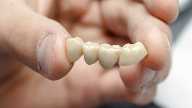 Ein Zahntechniker zeigt am 20.08.2013 im Zahntechniklabor "Flemming Dental" in Lübeck eine aus einem Stück gefräste und digital am Rechner gestaltete Keramikbrücke (Foto: picture-alliance / Reportdienste, picture alliance / dpa Themendienst | Markus Scholz) Ein Zahntechniker zeigt am 20.08.2013 im Zahntechniklabor "Flemming Dental" in Lübeck eine aus einem Stück gefräste und digital am Rechner gestaltete Keramikbrücke