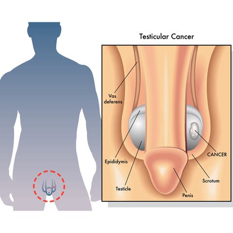 Medizinische Illustration von Hodenkrebs