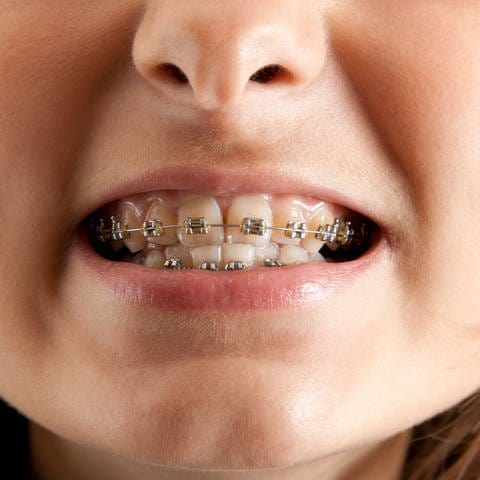 Ein Mädchen lächelt mit Klammer auf den Zähnen.