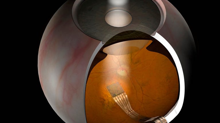 Die Grafik zeigt den Netzhaut-Chip der Firma Retina Implant im menschlichen Auge. (Foto: dpa Bildfunk, Retina Implant AG/dpa)